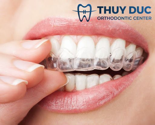 Hàm duy trì tháo lắp bằng khay nhựa trong suốt 1