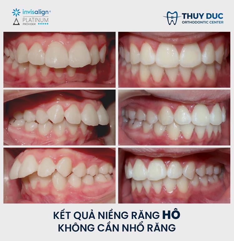 Niềng răng hô không cần nhổ bởi bác sĩ Phạm Hồng Đức AAO 1 Niềng răng hô không cần nhổ bởi bác sĩ Phạm Hồng Đức AAO 1