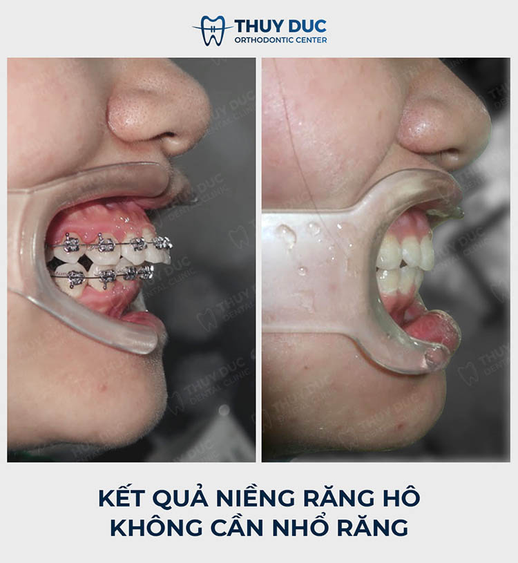 Niềng răng hô không cần nhổ bởi bác sĩ Phạm Hồng Đức AAO 2 Niềng răng hô không cần nhổ bởi bác sĩ Phạm Hồng Đức AAO 2