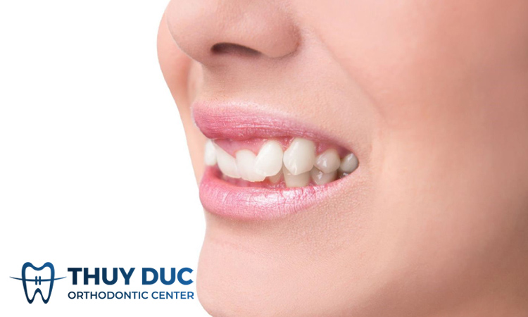 Trường hợp nào phải tạo khoảng trống niềng răng? 1 Trường hợp nào phải tạo khoảng trống niềng răng? 1