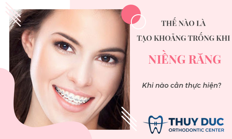 Tạo khoảng trống trước khi niềng răng là gì? Khi nào cần thực hiện 1 Tạo khoảng trống trước khi niềng răng là gì? Khi nào cần thực hiện 1