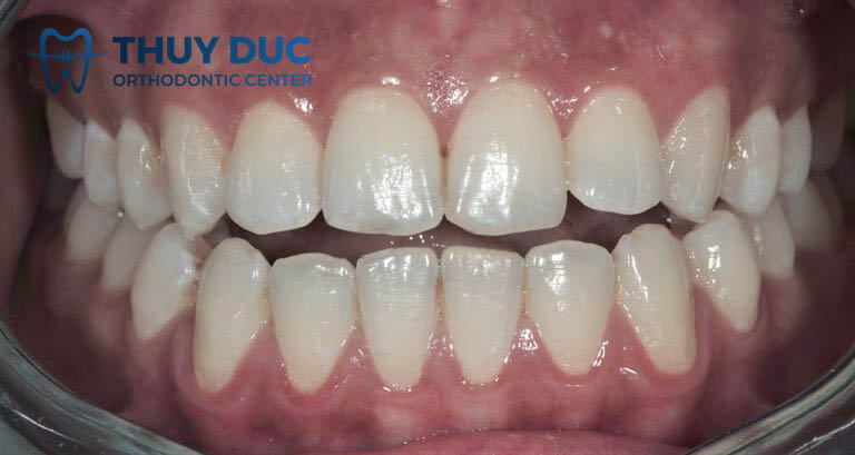 Khớp cắn hở là gì? 1 Khớp cắn hở là gì? 1