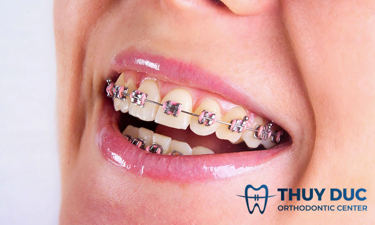 Nên niềng răng mắc cài nào? 1 Nên niềng răng mắc cài nào? 1