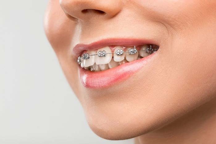 Giải đáp từ chuyên gia: Mất răng có niềng được không? 1 Giải đáp từ chuyên gia: Mất răng có niềng được không? 1