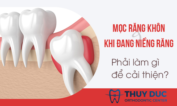 Mọc răng khôn khi đang niềng răng phải làm gì? 1 Mọc răng khôn khi đang niềng răng phải làm gì? 1