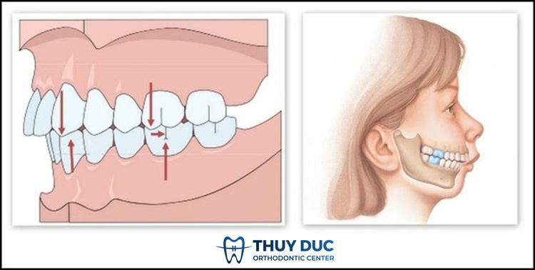 Răng hô vẩu do cả răng và hàm 1 Răng hô vẩu do cả răng và hàm 1