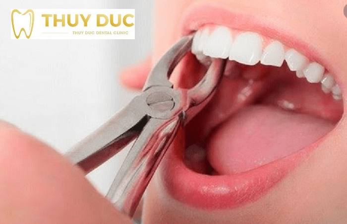 Niềng răng thường nhổ những răng nào? 1