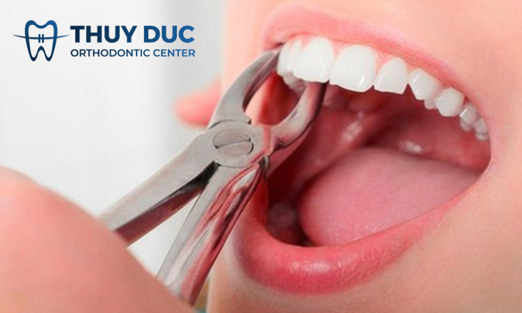 Nhổ răng 1 Nhổ răng 1