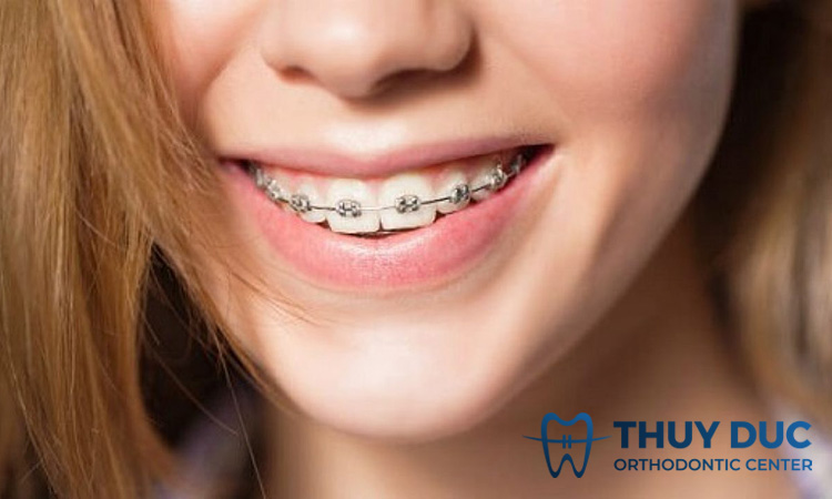 Mọc răng khôn khi đang niềng răng phải làm sao? 1 Mọc răng khôn khi đang niềng răng phải làm sao? 1