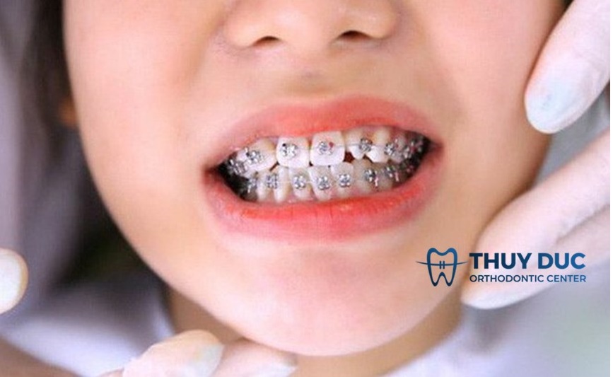 Trẻ em có cần niềng răng không?