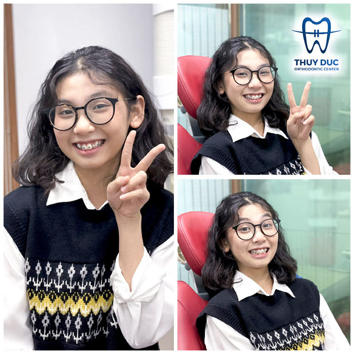 Thời gian niềng răng đối với trẻ em 1 Thời gian niềng răng đối với trẻ em 1