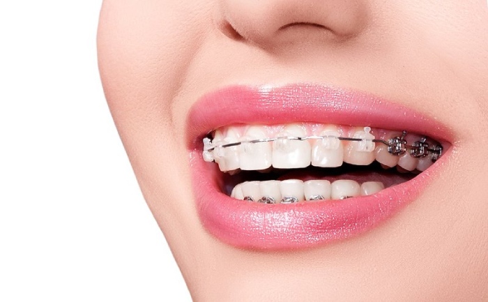 Bôi sáp nha khoa tại vị trí mắc cài Bôi sáp nha khoa tại vị trí mắc cài