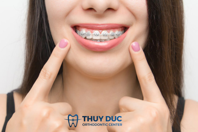 Niềng răng mắc cài kim loại thường 1 Niềng răng mắc cài kim loại thường 1