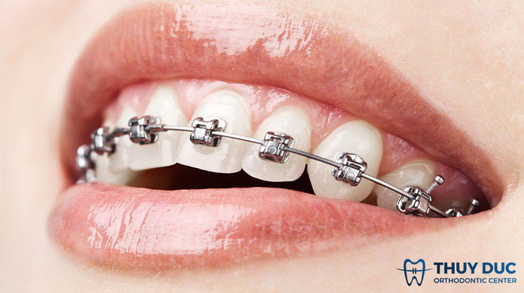 Niềng răng mắc cài kim loại tự đóng/tự khóa 1 Niềng răng mắc cài kim loại tự đóng/tự khóa 1