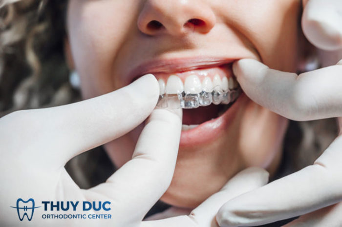 Niềng răng điều trị răng thưa 3