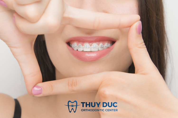 Khắc phục bằng phương pháp niềng răng 1 Khắc phục bằng phương pháp niềng răng 1