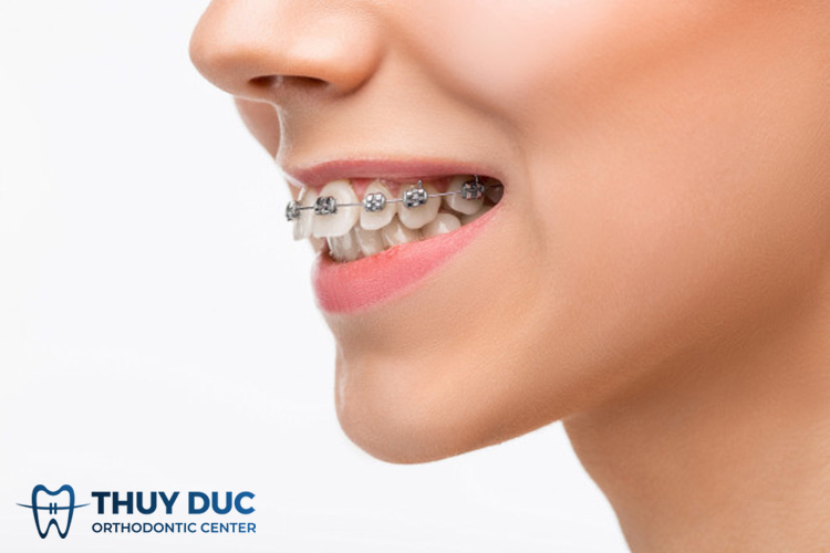 Niềng răng mắc cài kim loại 1 Niềng răng mắc cài kim loại 1