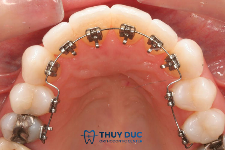 Niềng răng mắc cài mặt trong 1 Niềng răng mắc cài mặt trong 1