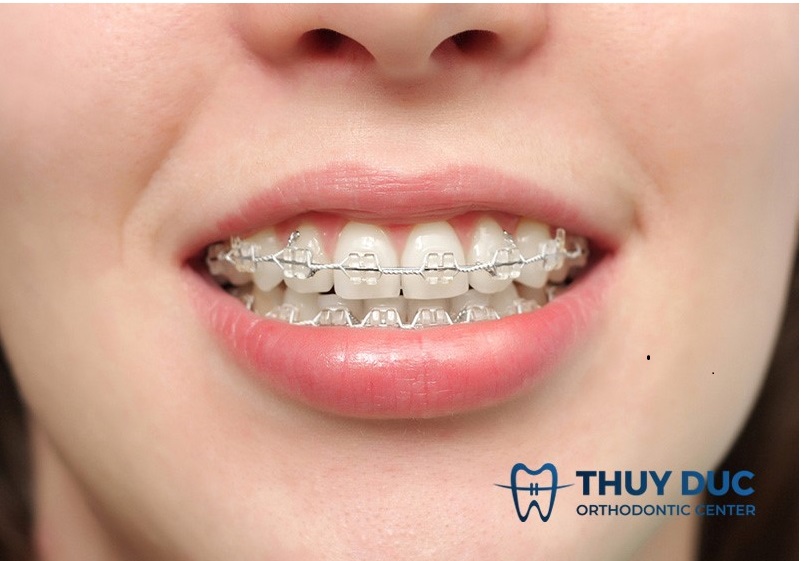 Đặc điểm của mắc cài pha lê và mắc cài sứ 1 Niềng răng bằng mắc cài pha lê và mắc cài sứ là sự lựa chọn của nhiều người.