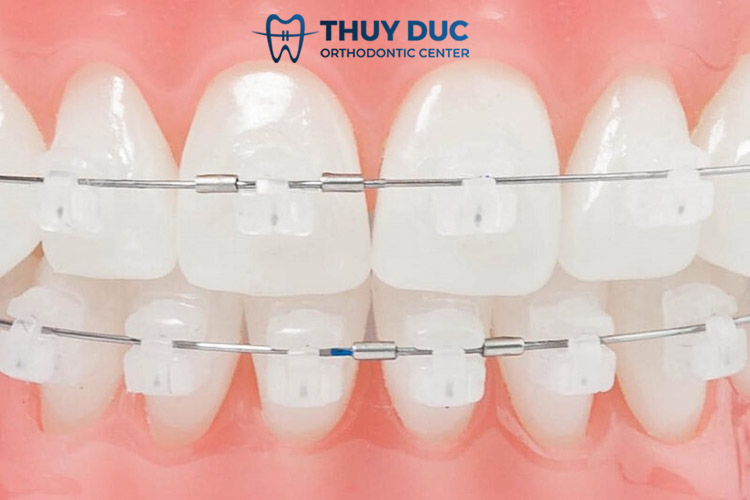 Niềng răng mắc cài sứ 1 Niềng răng mắc cài sứ 1