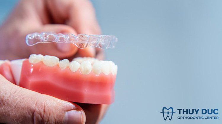 Niềng răng trong suốt Invisalign 1 Niềng răng trong suốt Invisalign 1