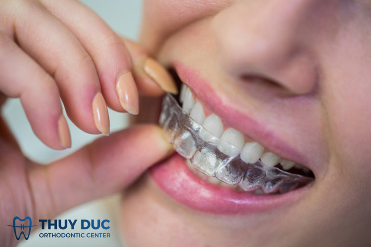 Niềng răng trong suốt Invisalign 1 Niềng răng trong suốt Invisalign 1