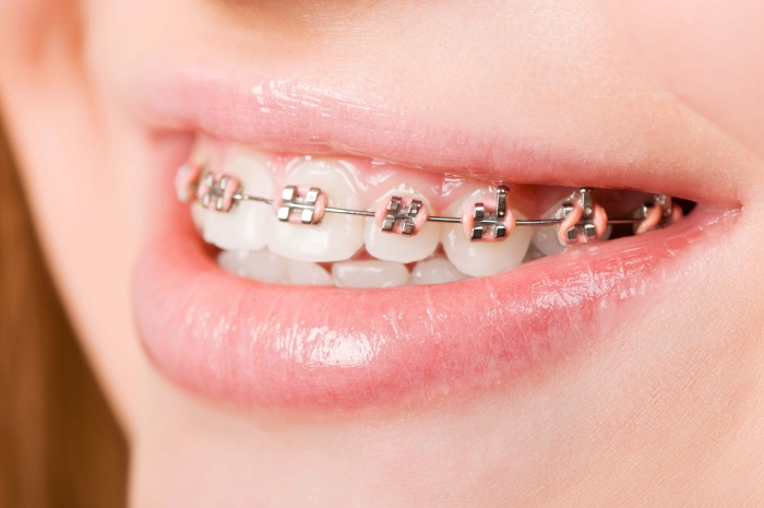 Làm thế nào để đập ra và chườm những miếng đá nhỏ trong miệng để giảm đau sau khi niềng răng?