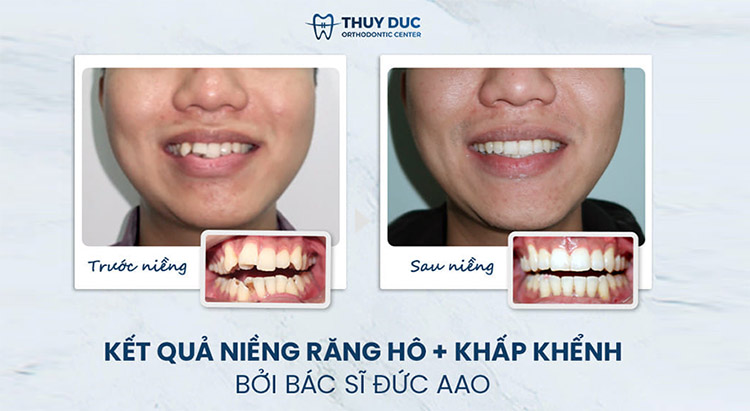 Quá trình niềng răng khấp khểnh diễn ra thế nào? 1