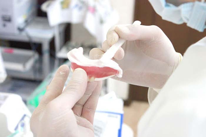 Bước 2: Vệ sinh răng miệng và lấy dấu hàm 1 Bước 2: Vệ sinh răng miệng và lấy dấu hàm 1