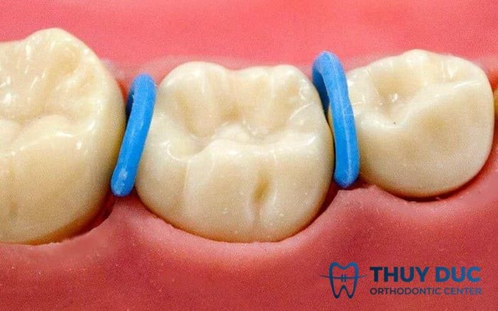 Bước 3: Gắn khí cụ niềng răng (quy trình gắn khí cụ sẽ tùy theo từng trường hợp mỗi bệnh nhân) 1