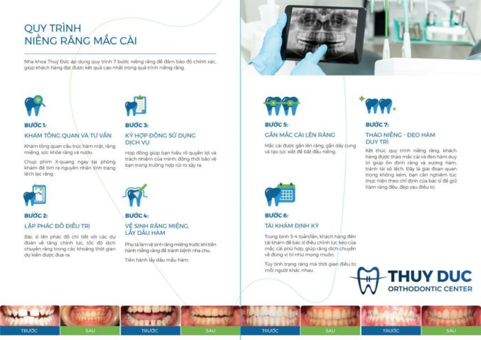 Quy trình niềng răng mắc cài tại Nha khoa Thúy Đức 1