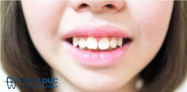 Răng hô là như thế nào? 1 Răng hô là như thế nào? 1