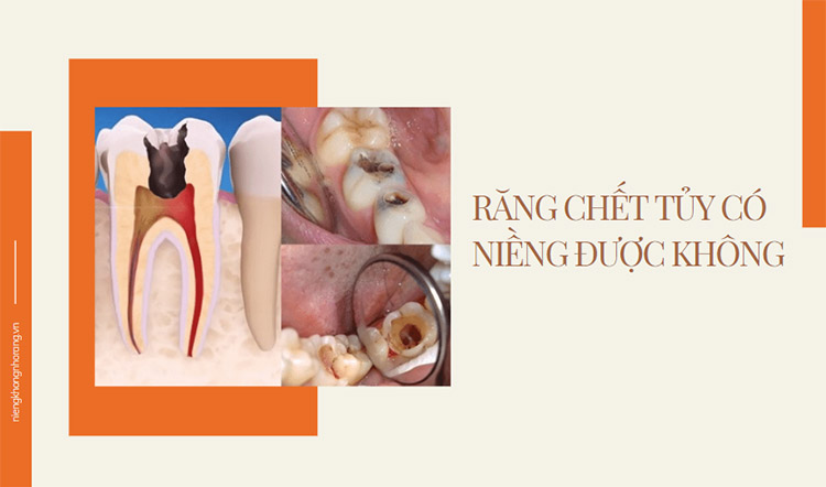 Răng chết tủy có niềng được không ? Giải đáp của chuyên gia 1