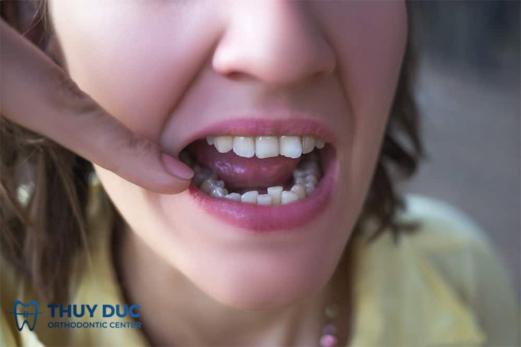Những ảnh hưởng của răng khấp khểnh 1 Những ảnh hưởng của răng khấp khểnh 1