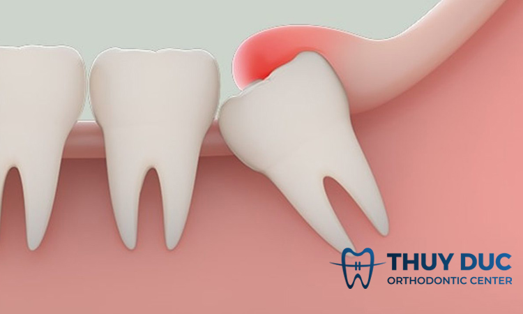 Răng khôn mọc ở đâu? Mọc khi nào? 1 Răng khôn mọc ở đâu? Mọc khi nào? 1