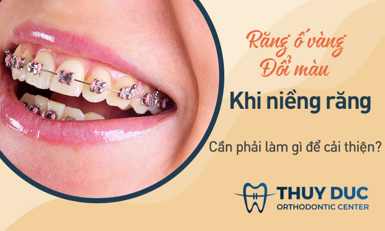 Răng bị ố vàng, đổi màu khi niềng răng phải làm sao? 1
