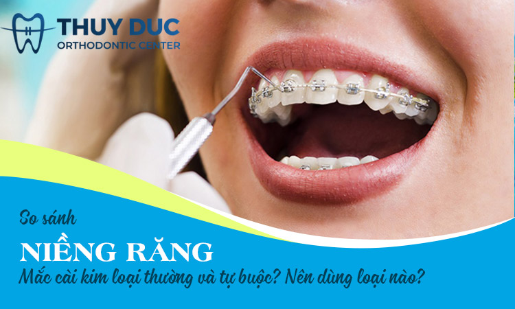 Có những lợi ích gì khi chọn niềng răng mắc cài buộc chun?
