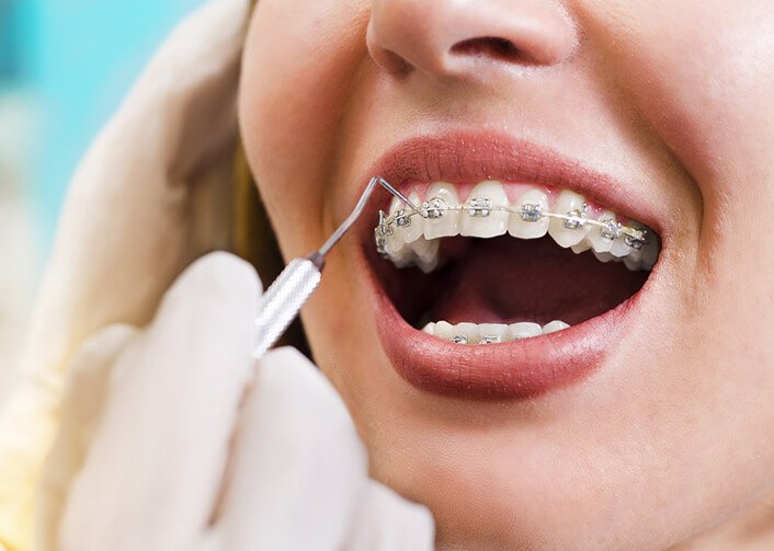 Thời gian tháo niềng răng Bao lâu thì được tháo niềng răng? 1