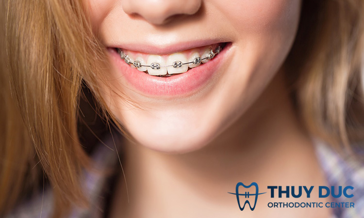 Niềng răng mắc cài kim loại thường 1 Niềng răng mắc cài kim loại thường 1