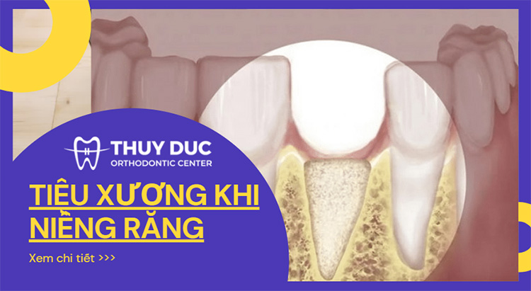 Điều gì gây ra hiện tượng tiêu xương hàm trong trường hợp niềng răng?
