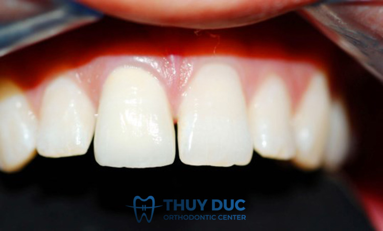 Răng cửa to 1 Răng cửa to 1