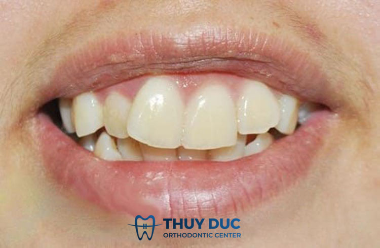 Răng cửa vừa to, vừa hô 1 Răng cửa vừa to, vừa hô 1