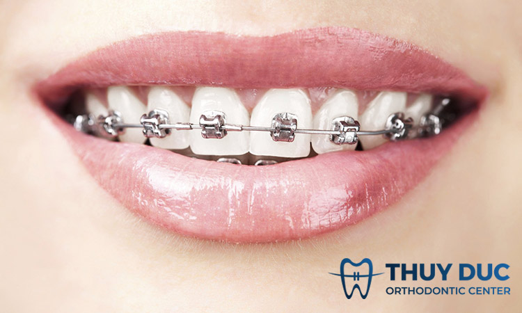 Niềng răng mắc cài kim loại tự buộc 1 Niềng răng mắc cài kim loại tự buộc 1