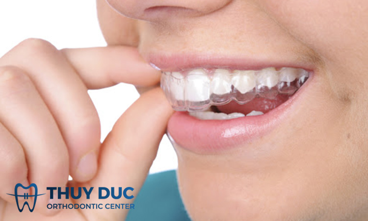 Niềng răng vô hình là gì? 1 Niềng răng vô hình là gì? 1