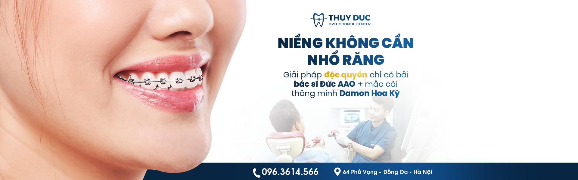 Niềng răng không nhổ răng F.A.C.E là gì? 1