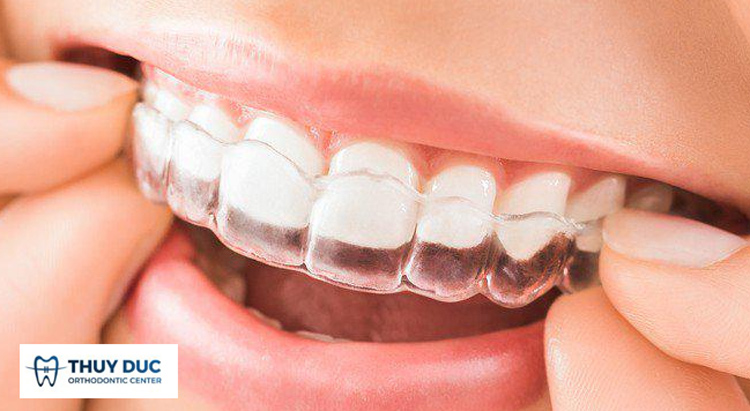 Niềng răng có dành cho bạn không? 1 Niềng răng có dành cho bạn không? 1