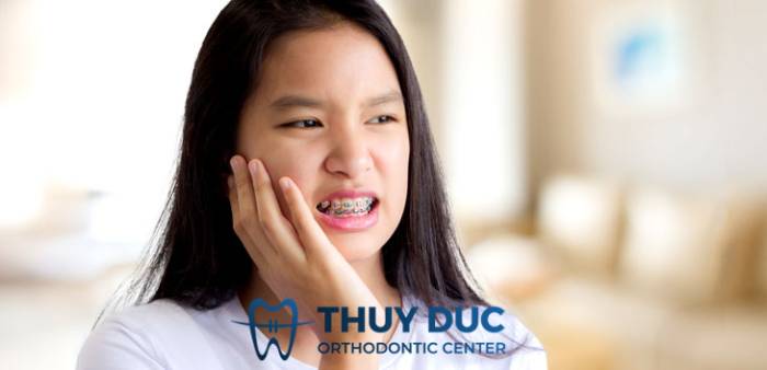 Mắc cài được gắn cố định chắc chắn, không thể tháo bỏ trong quá trình niềng răng 1 Mắc cài được gắn cố định chắc chắn, không thể tháo bỏ trong quá trình niềng răng 1