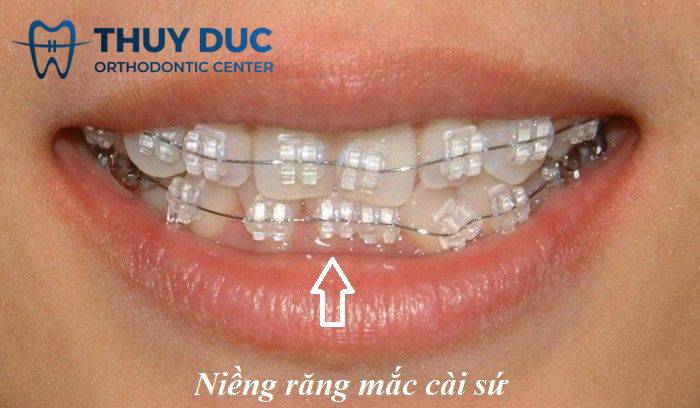 3. Chỉ trẻ em và thanh thiếu niên mới đủ điều kiện sức khỏe để chỉnh nha 1