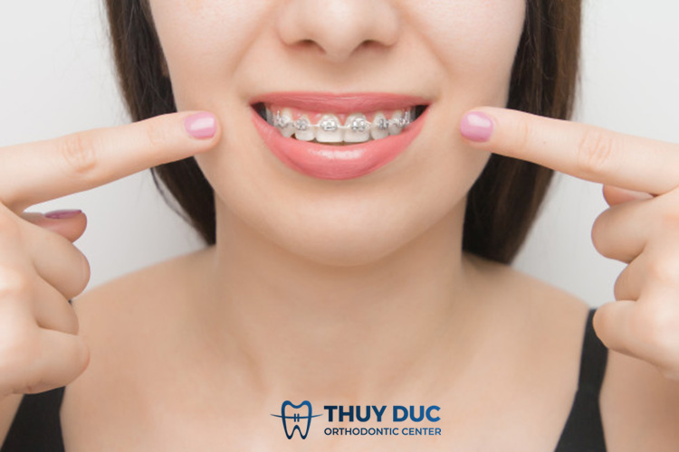 Phương pháp niềng răng 1 Phương pháp niềng răng 1