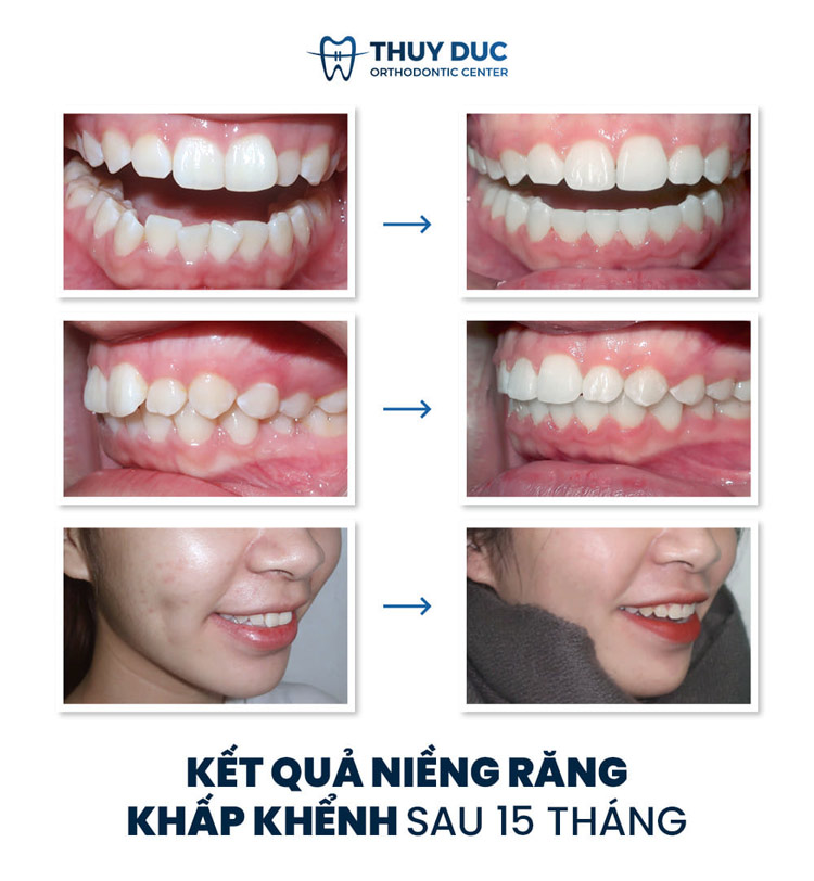 Thời gian chỉnh nha là bao lâu? 1